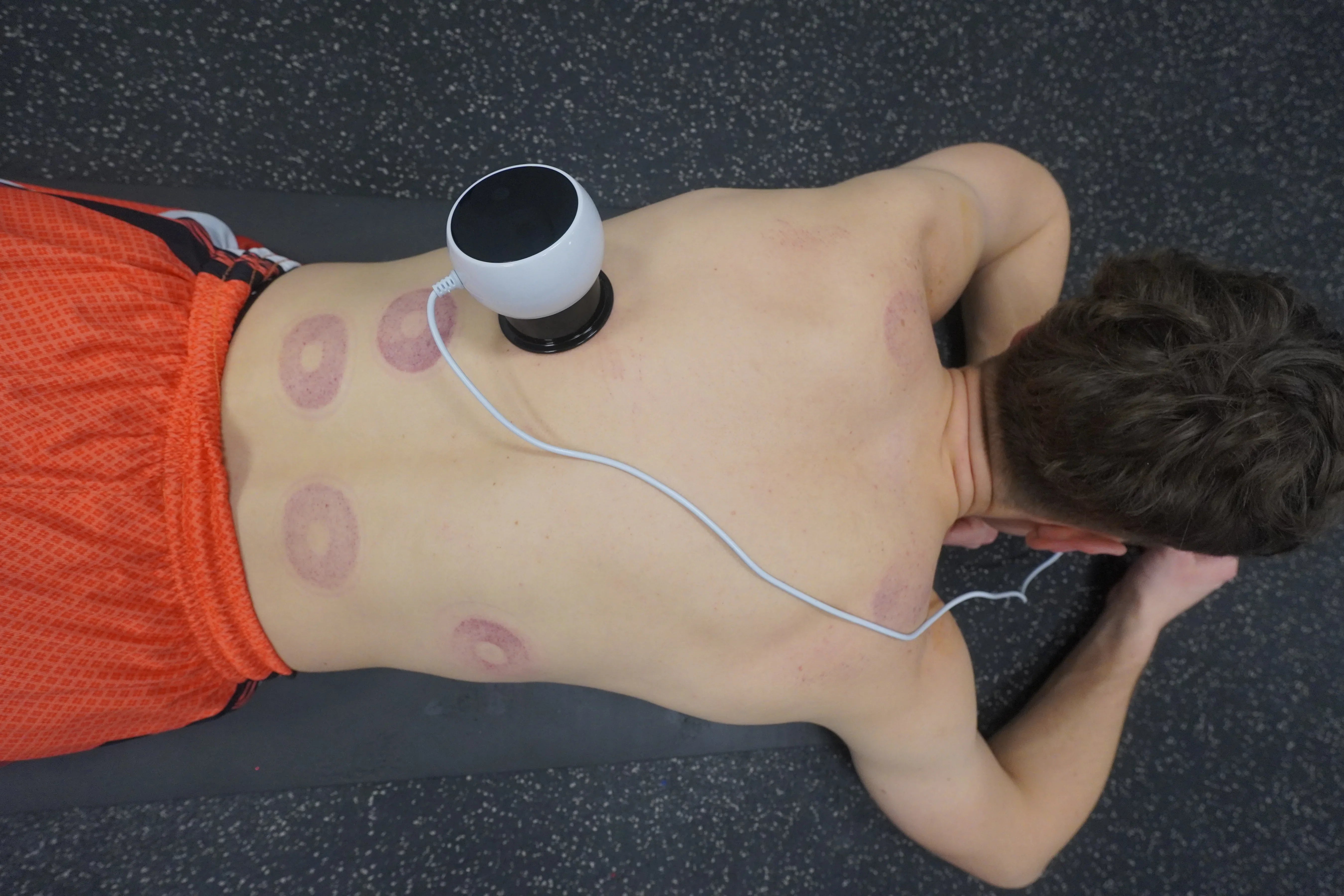 what-is-cupping-massage